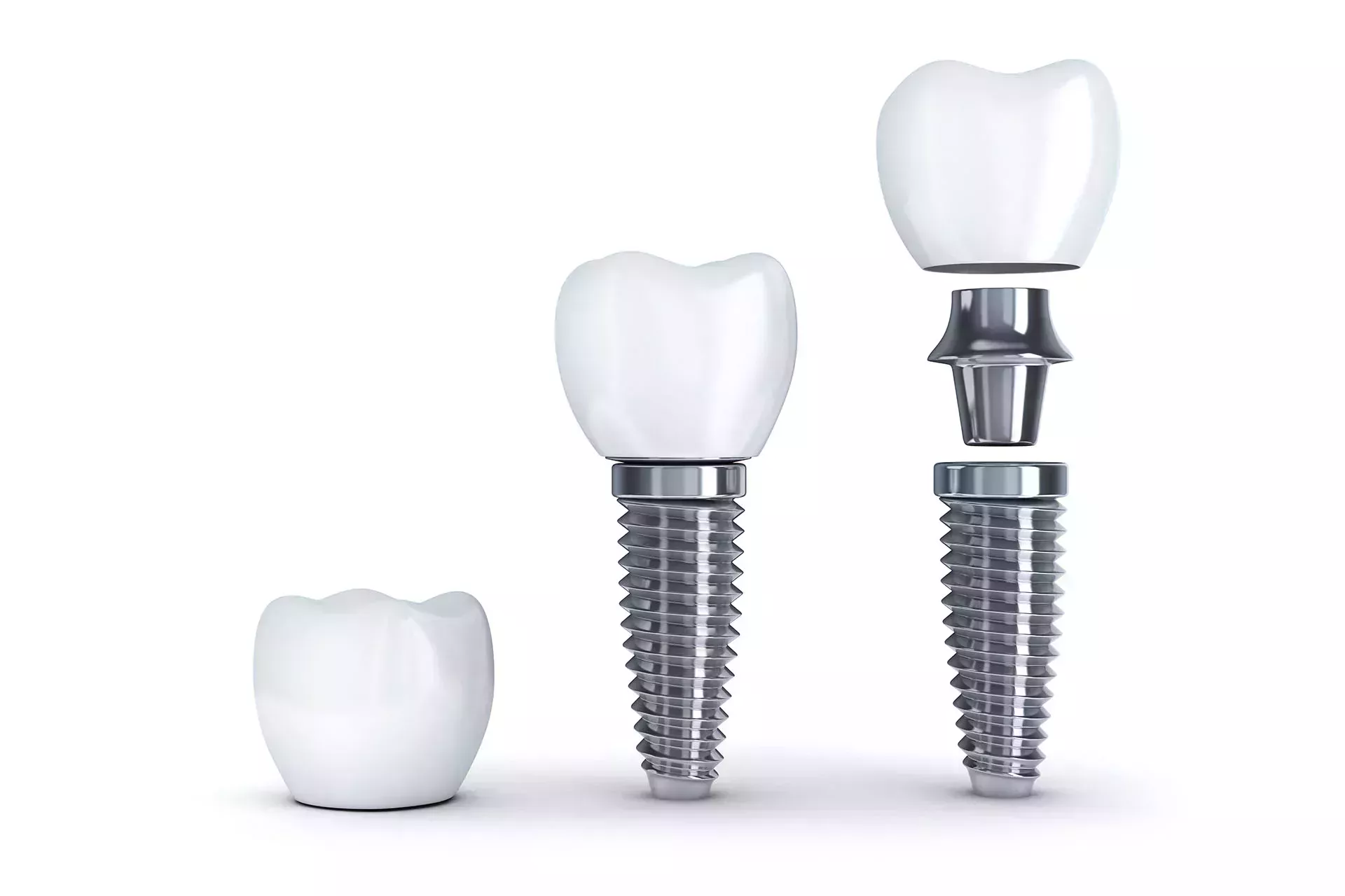 Build-up of dental implants